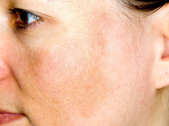 Melasma o cloasma