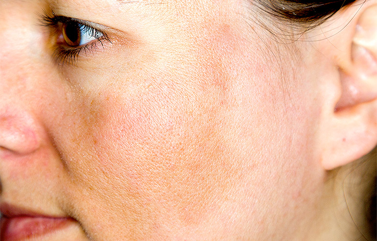 Melasma o cloasma