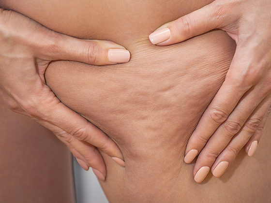 Cellulite e insufficienza vascolare