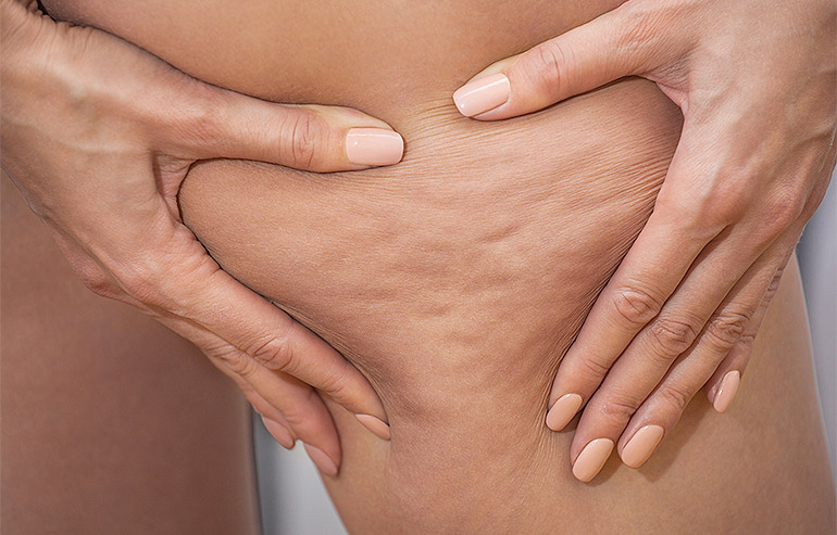 Cellulite e insufficienza vascolare